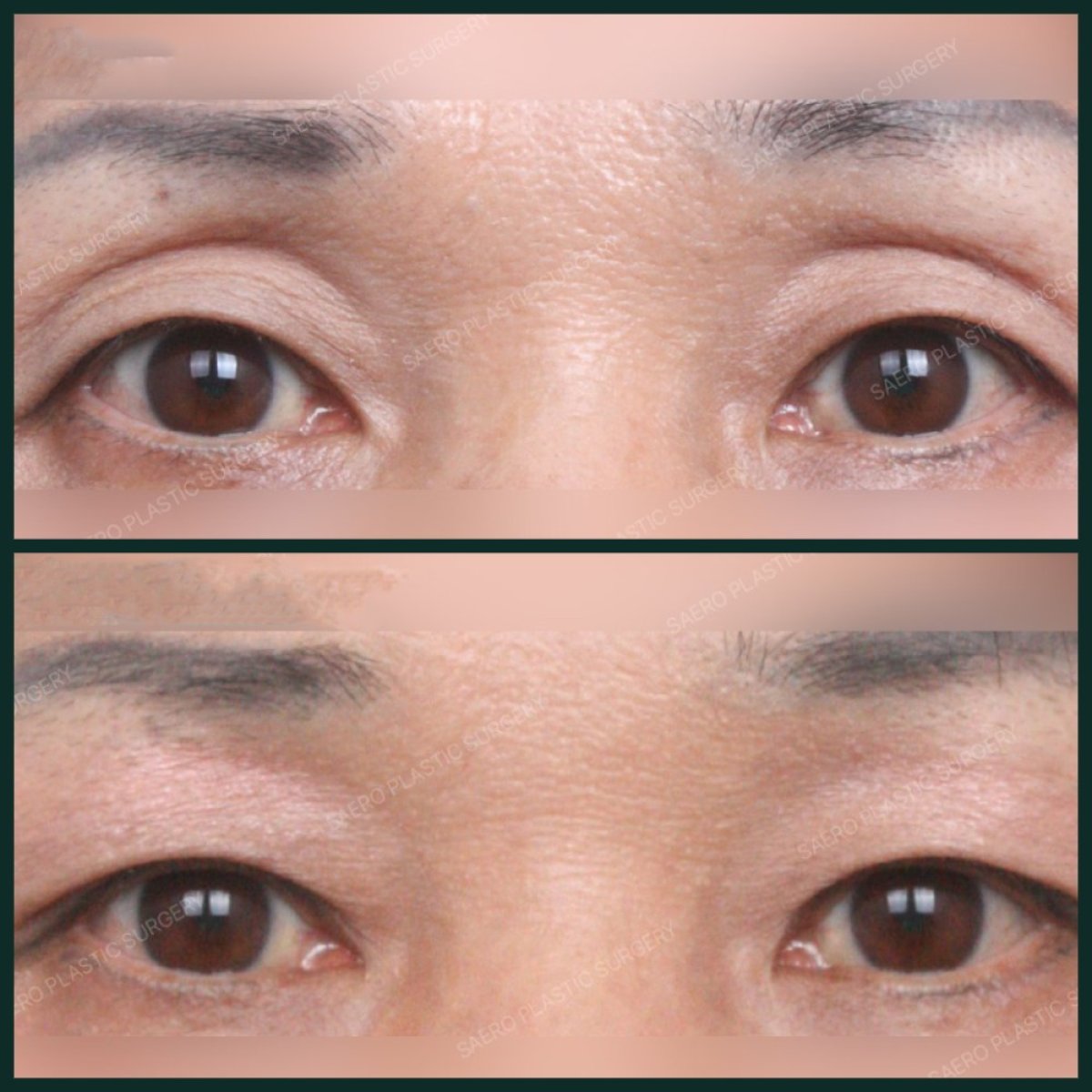 نتائج شد الجفن العلوي قبل وبعد في SAERO Plastic Surgery، تحسين مظهر الجفون