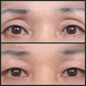 Upper eyelid surgery before and after results at SAERO Plastic Surgery, eyelid lift improvement