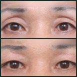 Upper eyelid surgery before and after results at SAERO Plastic Surgery, eyelid lift improvement