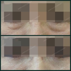 Before and after blepharoplasty results at SAERO Plastic Surgery, eyelid correction improvement