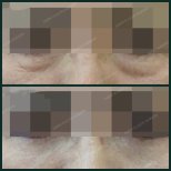 Before and after blepharoplasty results at SAERO Plastic Surgery, eyelid correction improvement