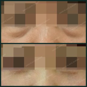 Before and after blepharoplasty results at SAERO Plastic Surgery, eyelid correction improvement