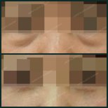 Before and after blepharoplasty results at SAERO Plastic Surgery, eyelid correction improvement