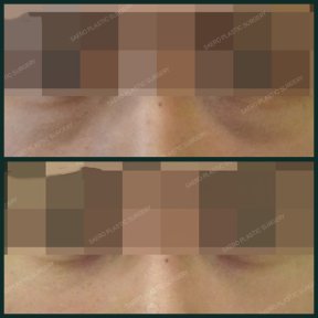 Before and after blepharoplasty results at SAERO Plastic Surgery, eyelid correction improvement