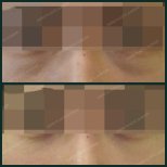 Before and after blepharoplasty results at SAERO Plastic Surgery, eyelid correction improvement