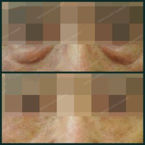 Before and after blepharoplasty at SAERO Plastic Surgery, eyelid correction visible result