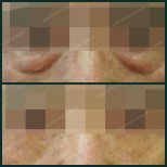 Before and after blepharoplasty at SAERO Plastic Surgery, eyelid correction visible result