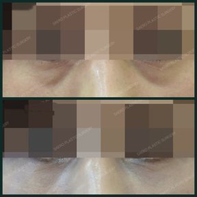 Before and after blepharoplasty results at SAERO Plastic Surgery, eyelid correction improvement