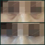 Before and after blepharoplasty results at SAERO Plastic Surgery, eyelid correction improvement