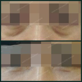 Before and after blepharoplasty results at SAERO Plastic Surgery, eyelid correction improvement