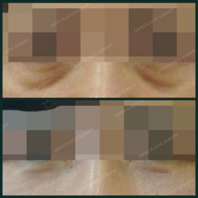 Before and after blepharoplasty results at SAERO Plastic Surgery, eyelid correction improvement
