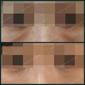 Before and after blepharoplasty results at SAERO Plastic Surgery, eyelid correction improvement