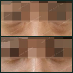 Before and after blepharoplasty results at SAERO Plastic Surgery, eyelid correction improvement