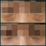 Before and after blepharoplasty results at SAERO Plastic Surgery, eyelid correction improvement