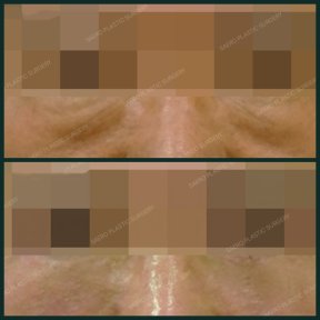 Blepharoplasty before and after results at SAERO Plastic Surgery, eyelid wrinkle reduction