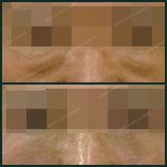 Blepharoplasty before and after results at SAERO Plastic Surgery, eyelid wrinkle reduction