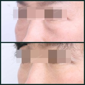 Before and after facial fat transfer at SAERO Plastic Surgery, under-eye volume improvement result
