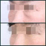 Before and after facial fat transfer at SAERO Plastic Surgery, under-eye volume improvement result