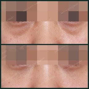 Before and after facial fat transfer at SAERO Plastic Surgery, under-eye volume improvement result