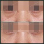 Before and after facial fat transfer at SAERO Plastic Surgery, under-eye volume improvement result