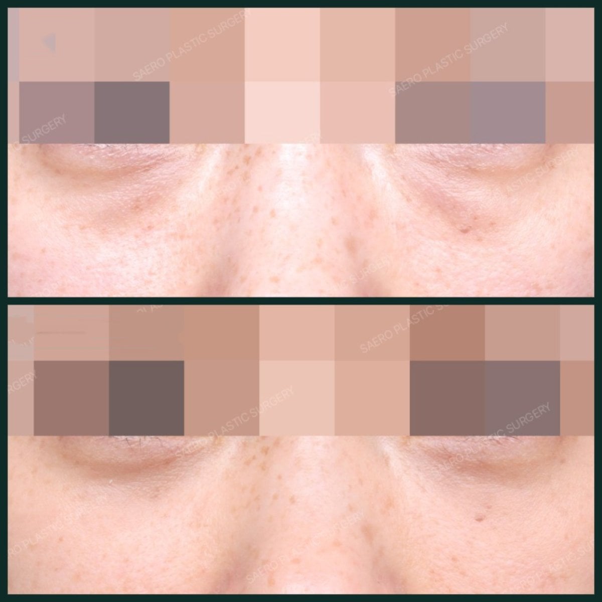 Resultados de transferencia de grasa facial en SAERO Plastic Surgery, mejora bajo los ojos