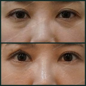 Before and after facial fat transfer at SAERO Plastic Surgery, under-eye rejuvenation result
