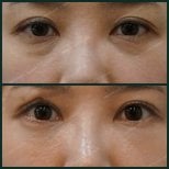 Before and after facial fat transfer at SAERO Plastic Surgery, under-eye rejuvenation result