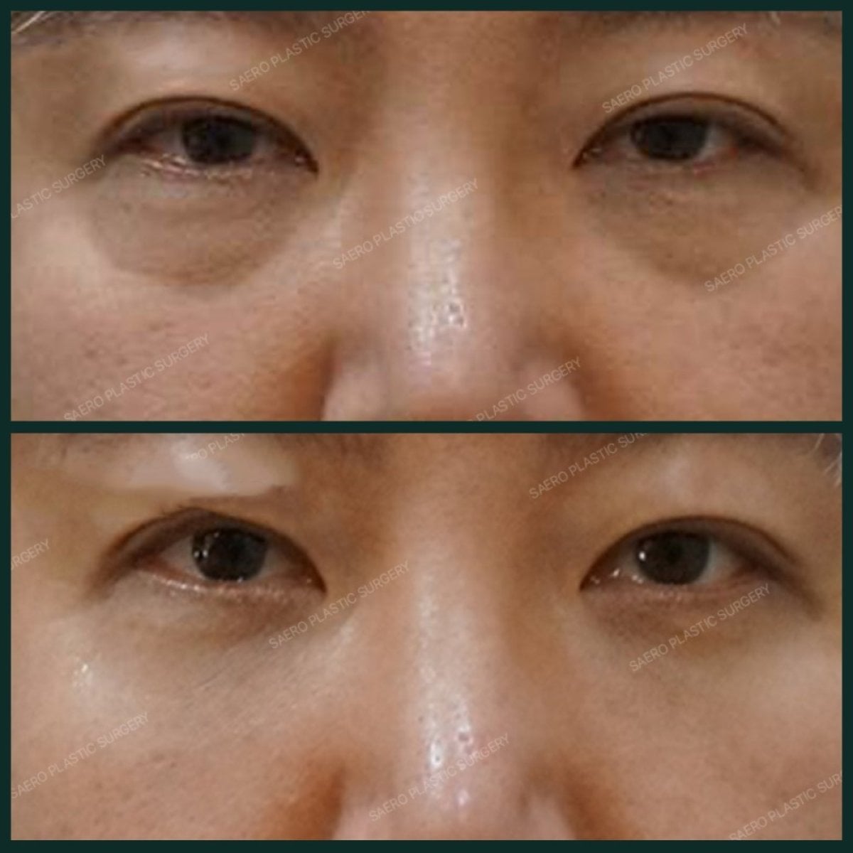 نتائج قبل وبعد نقل الدهون للوجه في SAERO Plastic Surgery، تجديد تحت العينين
