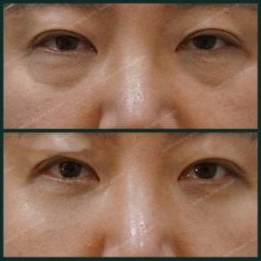 Before and after facial fat transfer at SAERO Plastic Surgery, under-eye rejuvenation result