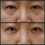 Before and after facial fat transfer at SAERO Plastic Surgery, under-eye rejuvenation result