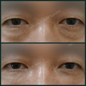 Before and after facial fat transfer at SAERO Plastic Surgery, under-eye rejuvenation result