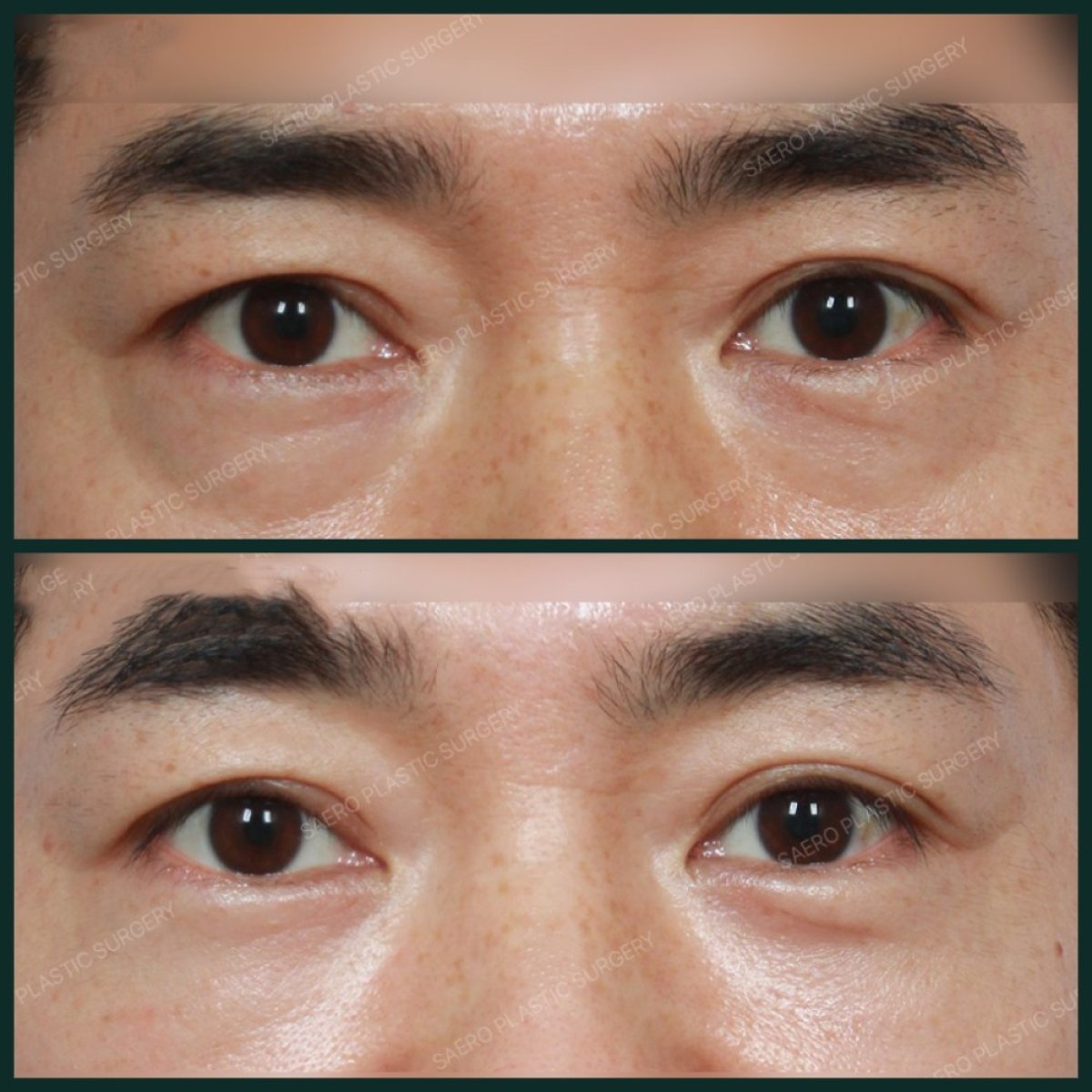 نتيجة نقل الدهون للوجه في SAERO Plastic Surgery، تحسين حجم تحت العينين
