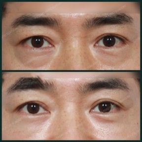 Before and after facial fat transfer at SAERO Plastic Surgery, under-eye volume improvement result