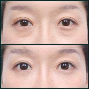 Before and after facial fat transfer at SAERO Plastic Surgery, under-eye volume restoration result