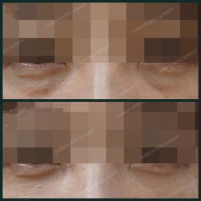 Before and after facial fat transfer at SAERO Plastic Surgery, under-eye volume improvement result