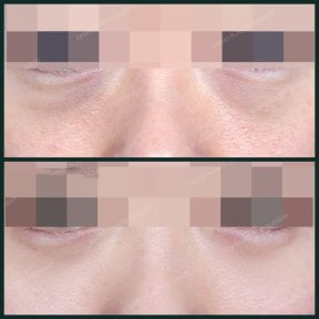 before-after photo facial-fat-transfer