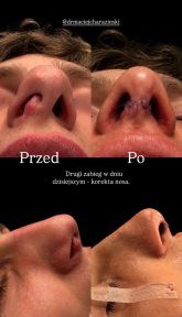 before-after photo rinoplastika-plastika-nosa