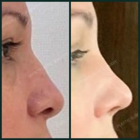 before-after photo rhinoplasty-nose-job