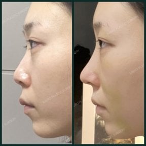 before-after photo rhinoplasty-nose-job