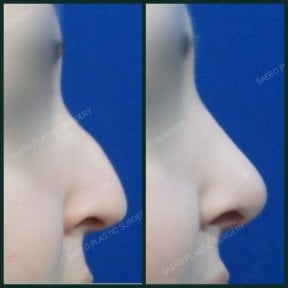 before-after photo rhinoplasty-nose-job