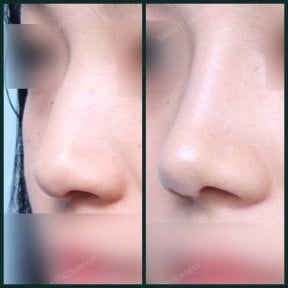 before-after photo rhinoplasty-nose-job