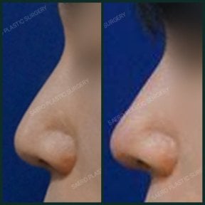 before-after photo rhinoplasty-nose-job