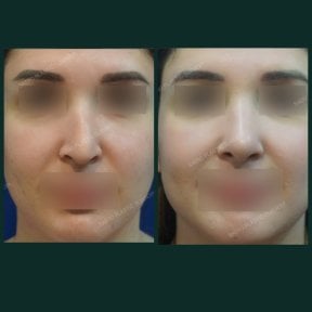 before-after photo rhinoplasty-nose-job