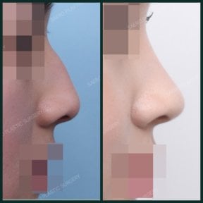 before-after photo rhinoplasty-nose-job