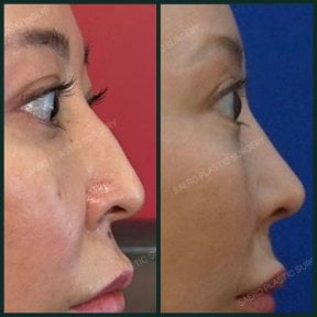 before-after photo rhinoplasty-nose-job