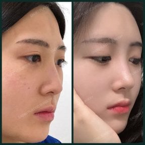 before-after photo rhinoplasty-nose-job