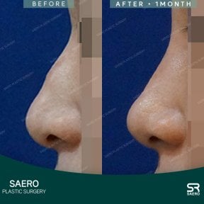 before-after photo rhinoplasty-nose-job