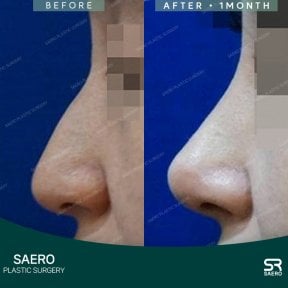 before-after photo rhinoplasty-nose-job