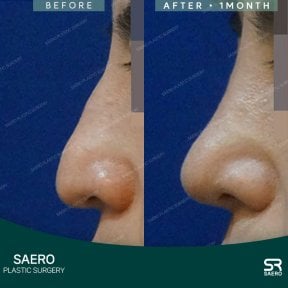 before-after photo rhinoplasty-nose-job