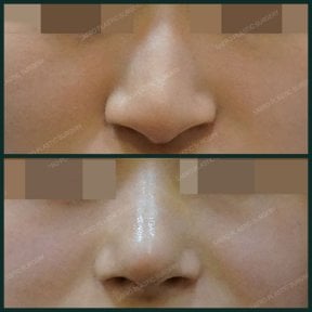 before-after photo rhinoplasty-nose-job